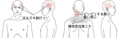頭痛の症例_鍼灸_KMTT261226