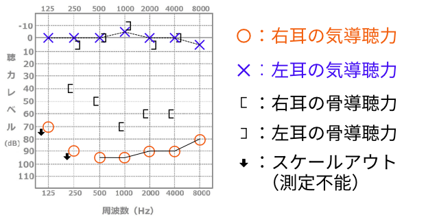 オージオグラム 聴力検査表 の見方を説明します 品川駅周辺 はりきゅう専門の鍼灸院 はりきゅうルーム カポス