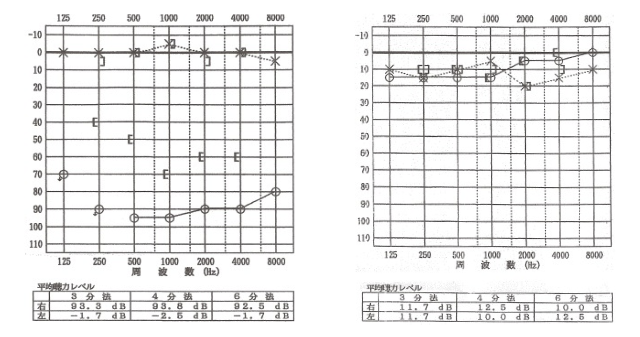 オージオグラム 聴力検査表 の見方を説明します 品川駅周辺 はりきゅう専門の鍼灸院 はりきゅうルーム カポス